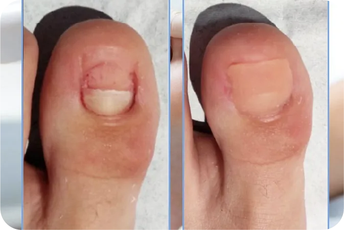 Reconstrucción de Uña — Professional Feet Panamá