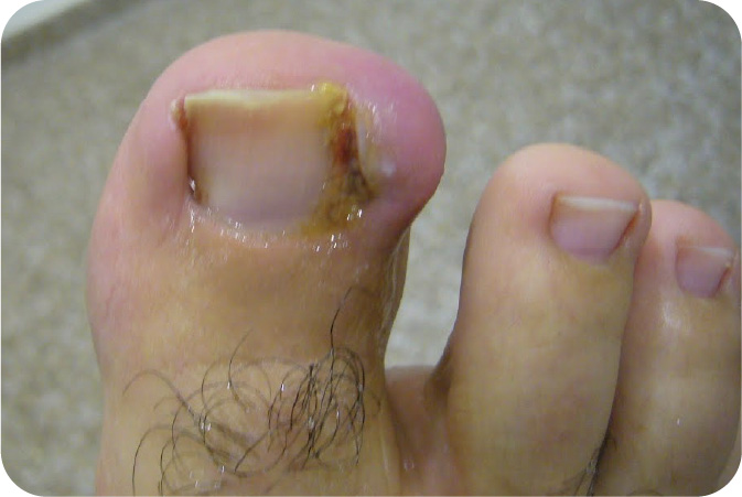 Uña Encarnada — Professional Feet Panamá