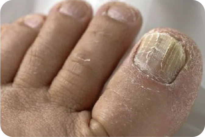 Tratamiento Anti Hongos — Professional Feet Panamá